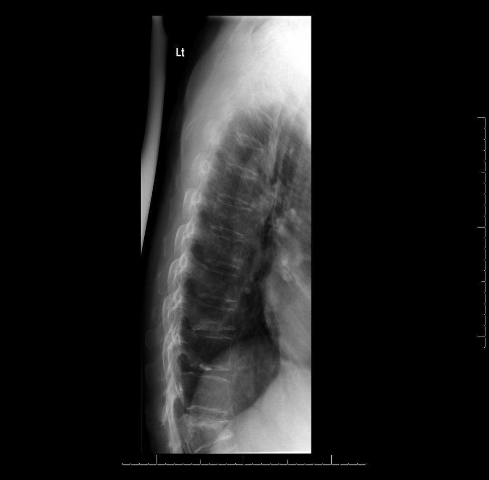 OP case - lateral thoracic spine xray