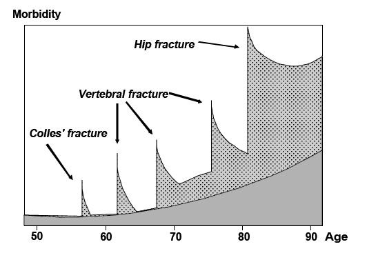 Fragility fractures cause significant morbidity Additional morbidity due to fragility fracture event Morbidity attributable to ageing alone Hip fracture is all too often the final destination of