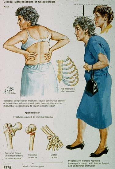 Osteoporosis Progression of