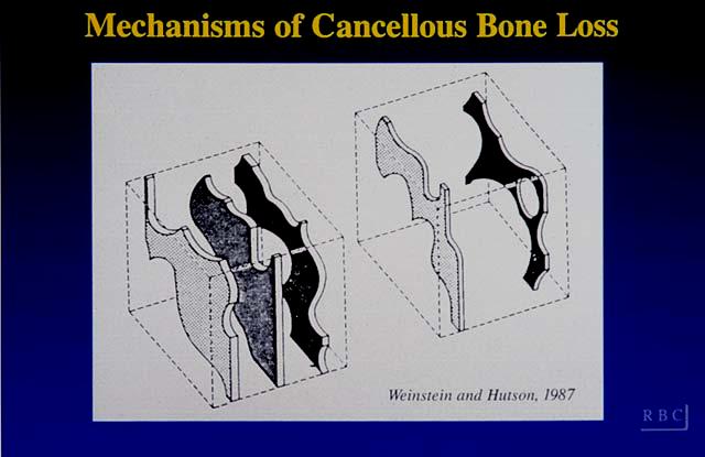 Mechanisms of Cancellous Bone Loss 1 2 Cancellous bone volume (%) 30 25 20 15 10 10 Female Male 20 30 40 50 60 70 80 90 Age (years) Slow Loss 3 Rapid Loss Old Bone New Bone 1. Meunier P et al.