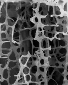 OSTEOPOROSIS Normal
