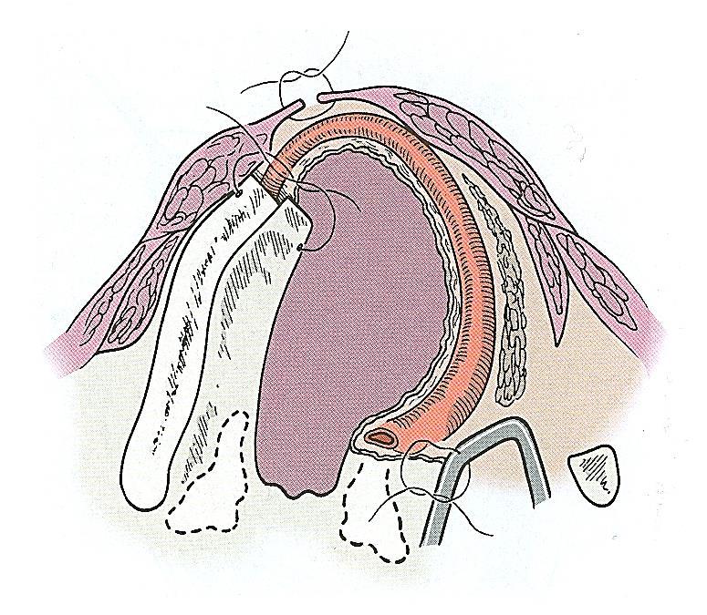 Figure 5: The cartilage cuts must be perpendicular to the cartilage to allow for corresponding soft tissue cuts in the larynx A wide cricothyrotomy allows access to the subglottis such that the