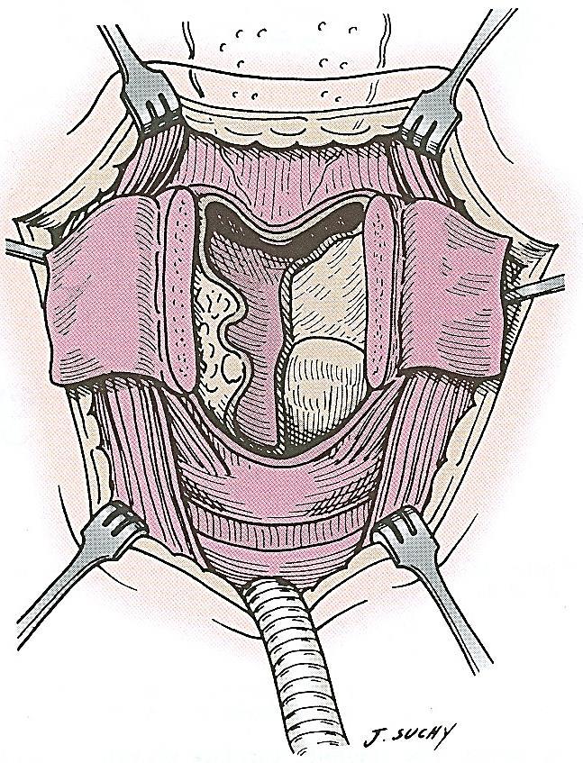 uninvolved vocal fold. The thyrotomy is then opened widely such that the cut across the posterior aspect of the involved vocal fold can be accomplished with a 2mm margin and the specimen removed.
