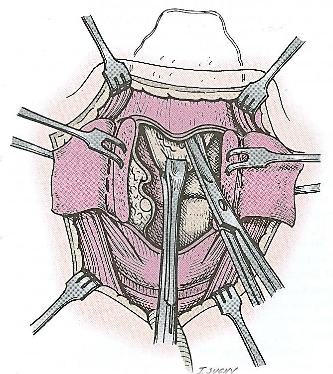 The petiole of the epiglottis is grasped with an Allis forceps, and the hyoepiglottic ligament freed such that the epiglottis can be mobilized and pulled inferiorly and fixed to the superior surface
