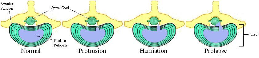 Stages of IVD Degeneration Protrusion - fluid inside disc stretches fibers Herniation - rupture of fibers,