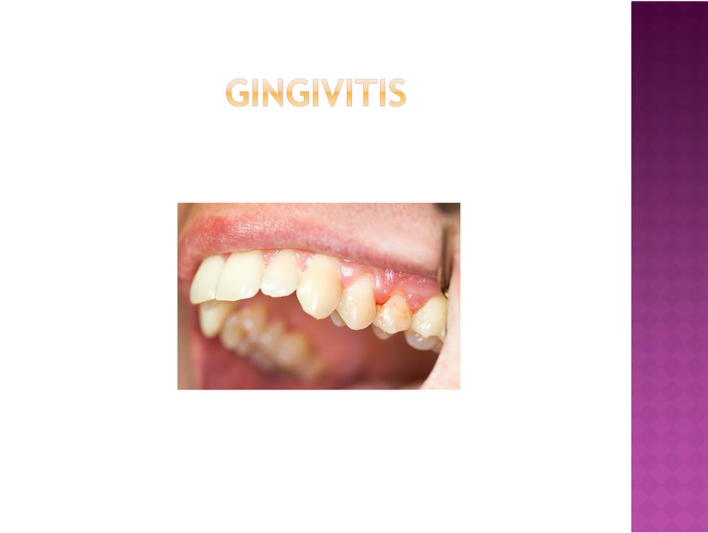 Gingivitis means an inflammation of the gingival or gum. This is when the reddish pink area that is around your teeth gets irritated. Then it turns redder and swells or gets bigger.
