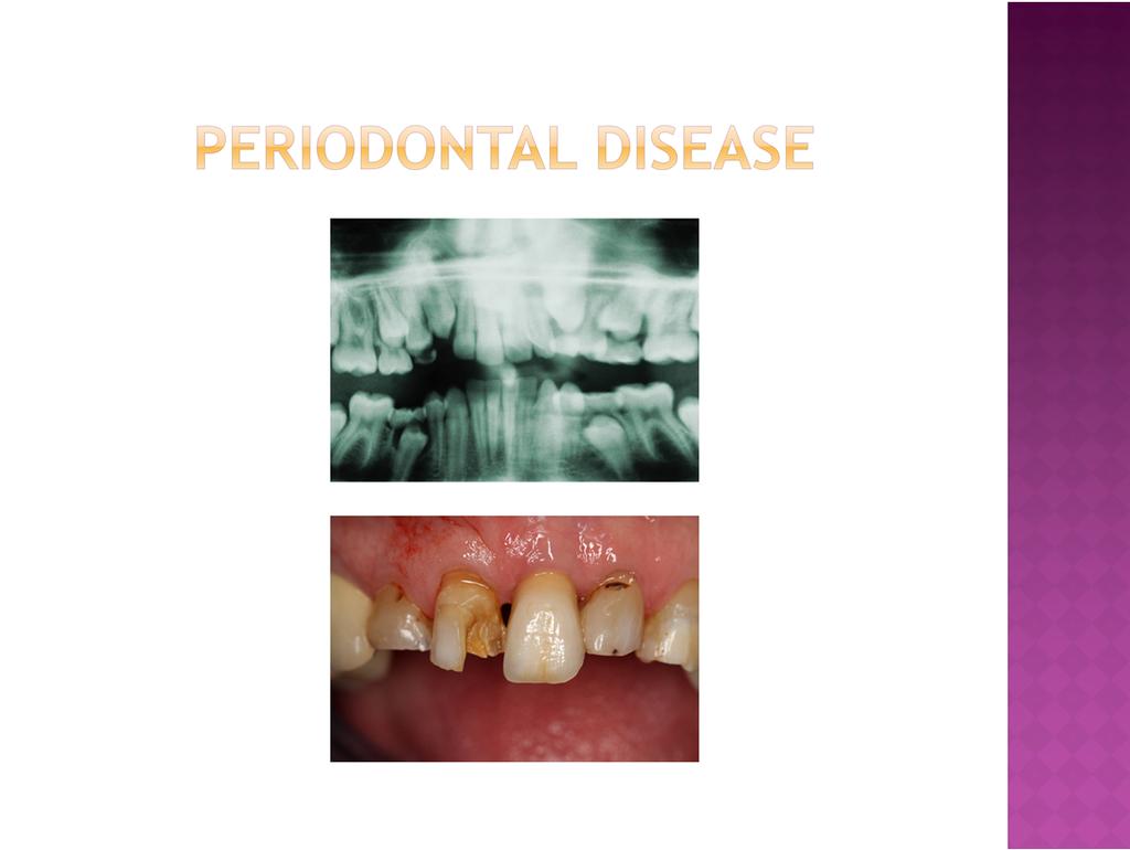 What is periodontal disease? Peri means around. Dontal means teeth. So periodontal disease is an infection around the teeth and bones in the jaw.