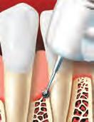 At follow-up visits, your dentist or hygienist will measure the pocket depths to see if scaling and root planing has been successful.