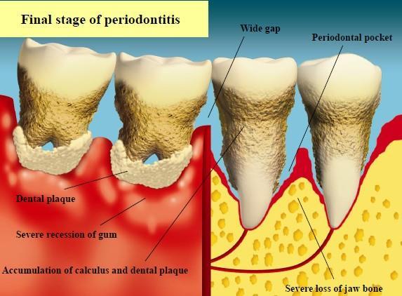 Gum disease Progression of gum disease takes time Early disease=gum bleeding, red gums, no signs http://www.toothclub.gov.