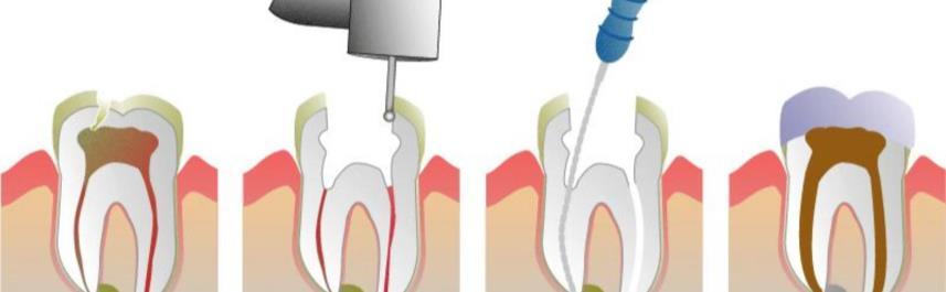 Extraction Replacement of teeth if
