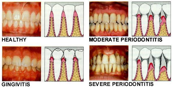 2. Gum disease ( Gingivitis, Periodontal disease) Symptoms: Bleeding, pain and swollen gums Bad
