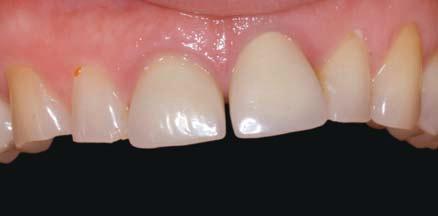 conditions. Implementing this plan also depends on the selection of the appropriate temporary and definitive restorative materials to satisfy clinical and esthetic requirements.