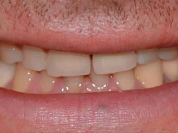1 An inadequate temporary restoration may compromise the final results, ie, improper fit that may result in gingival irritation and discomfort, compromised esthetics and occlusion, and subsequent