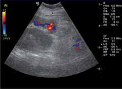 Figure 1. Ultrasound image showing the classic pattern of angiomyolipoma. Figure 2. Characteristic hypomelanotic macule. Figure 3.