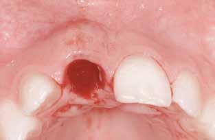 The crater-like defect exposing a part of the buccal implant surface is covered with locally harvested