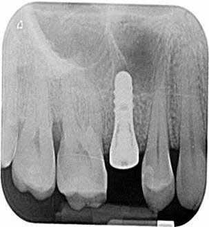 Clinical Cases Early implant placement