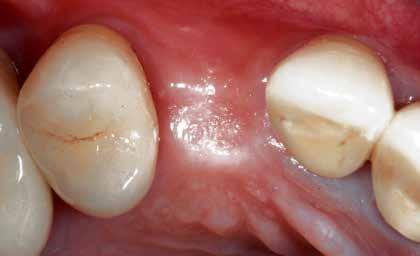 Clinical Cases Delayed implant placement