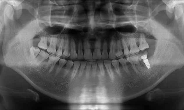 Clinical Cases Late implant placement