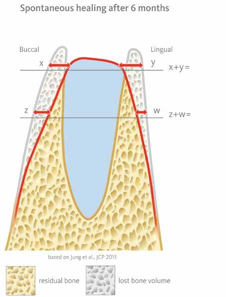 Treatment Options > Why Ridge Preservation Minimise Invasion: Bone volume preservation Minimise Invasion: Bone volume preservation Spontaneous healing after 6 months Ridge Preservation with