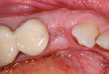Healing of the soft tissues 2 weeks after tooth extraction and ridge