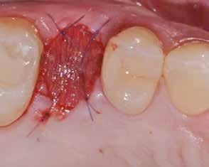 When should I place an implant What are the