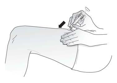 3. You may notice a small bubble in the pre-filled syringe. You do not have to remove the air bubble before injecting. Injecting the solution with the air bubble is harmless. 4.
