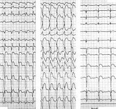 580 C 84258 The ECG diagnosis mportance of V dissociation lthough dissociation between atrial and ventricular activity during tachycardia is a hallmark of VT (fig 2), some form of V conduction can be