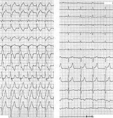 4 P waves can be diycult to recognise during a broad QRS tachycardia and it is always useful to look for nonelectrocardiographic signs such as variations in jugular pulsations, the loudness of the