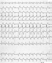 Two types of VT (panel and ) in the same patient (panel C during sinus rhythm). trioventricular dissociation is present during both VTs.
