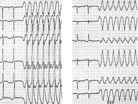 809 and R L F Figure 6. n antidromic circus movement tachycardia with V conduction over a right sided accessory pathway.
