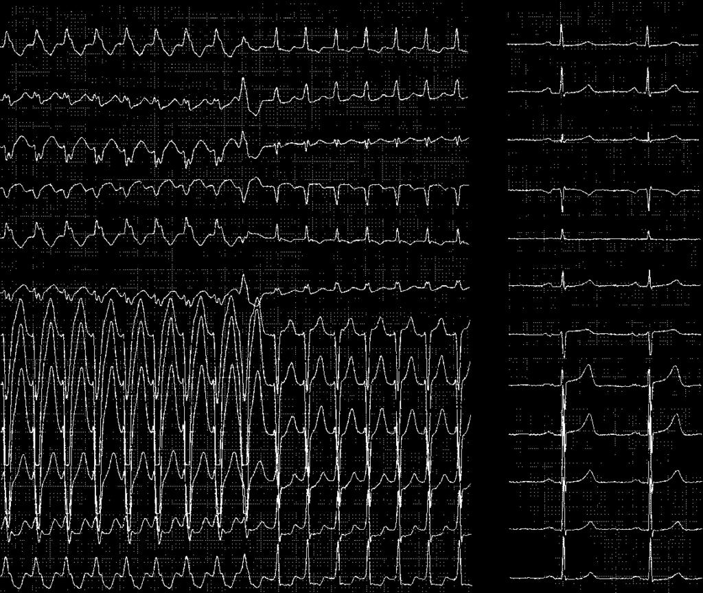 582 Figure 9. SVT with L. n panel L changes during tachycardia into a narrow QRS following a ventricular premature beat.
