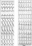 Configurational characteristics of the QRS complex Leads V1 and V6 Marriott 6 described that in R shaped tachycardia, presence of a qr or R complex in lead V1 strongly argued for a ventricular origin