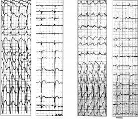 Figure 12. QRS complexes during VT indicating a myocardial scar.