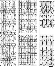 s shown in fig 11, a very wide QRS is present during sinus rhythm because of sequential activation of first the right and then the left ventricle. During tachycardia the QRS is more narrow.