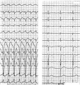 584 The QRS configuration in idiopathic left VT is shown in fig 14. They all have an R shape because of an origin in the left ventricle. The most common type is shown in panel.