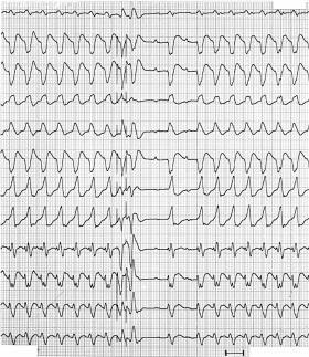 n panel the frontal QRS axis is further leftward (a so called north-west axis). This tachycardia arises more anteriorly close to the interventricular septum.