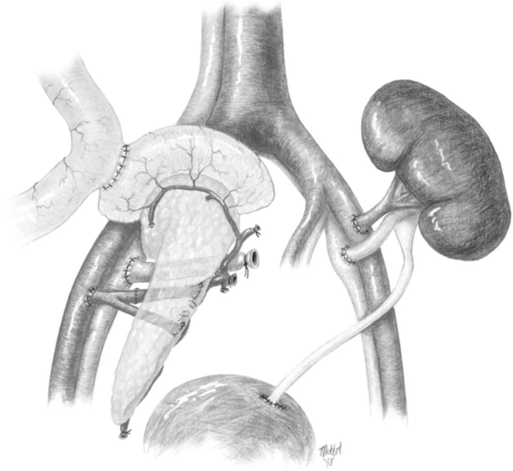 3 Bladder-drained (BD) pancreaticoduodenal transplant alone (PTA) from a cadaver donor.