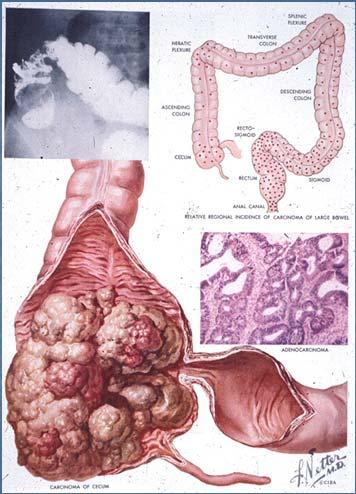 Colon Cancer Right and left side