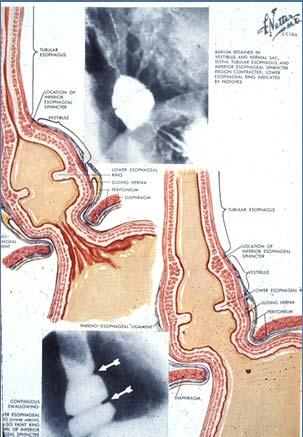 Esophageal Scarring and Ring formation Esophageal Diverticulae Inflammation