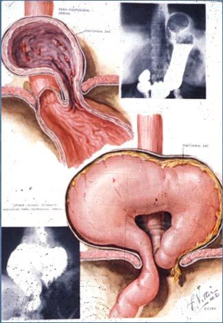 opening Portion of stomach is in thorax Sliding type -> Leads to Regurgitation
