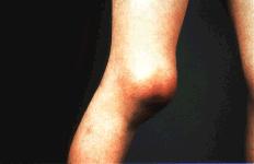 Joint Hemorrhages (Hemarthrosis) Most common problem in haemophilia Symptoms include prolonged bleeding, pain and