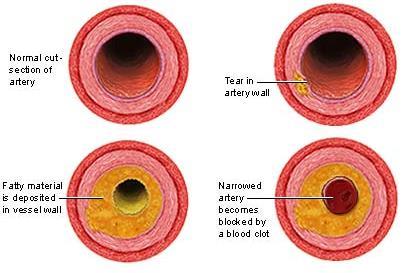 6 Atherosclerosis Narrowing of arteries due to plaque deposits (from cholesterol) ON the artery walls.