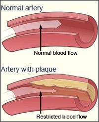 artery wall Plaque blocks blood flow, can cause blood clots which may break free, travel and cause heart attack or stroke.