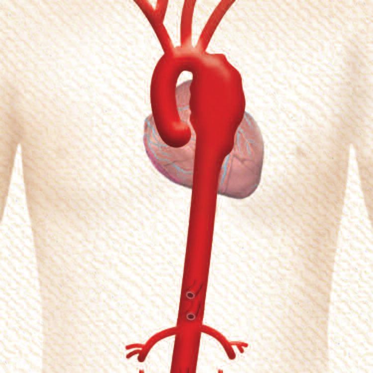 The main diseases of the aorta include aneurysms, dissections, traumatic ruptures (for example, after a traffic accident), ulcers, intra-mural hematomas, and fistulas.