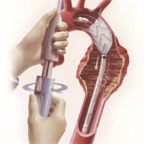 A thoracic stent graft is designed to exclude the diseased portion of the aorta and reinforce the weakened wall.