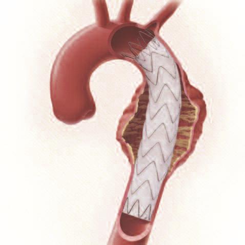 The stent graft comes inside a delivery catheter, a long, tube-like device used to transport and release the stent graft.