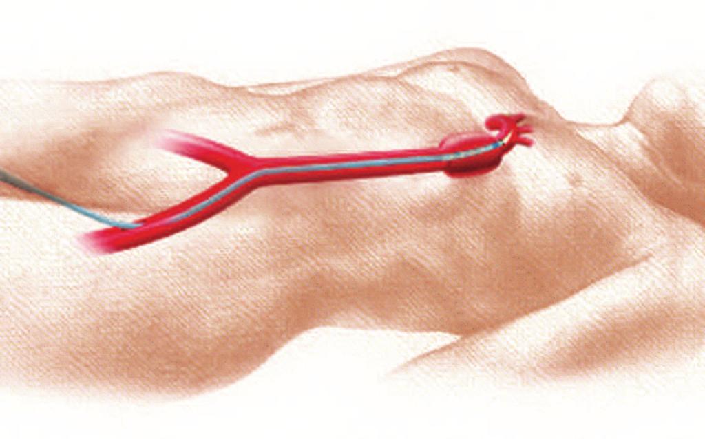The delivery catheter is inserted through a vessel in the patient s leg and into the aneurysm. The procedure is performed using either regional (e.g. via epidural) or general anesthesia.