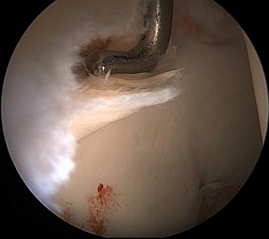 Hip Arthroscopy Increasingly common Clinical success in treating intra-articular hip pathology Labral tears, removal of loose or foreign bodies, pigmented villonodular synovitis, osteonecrosis, joint