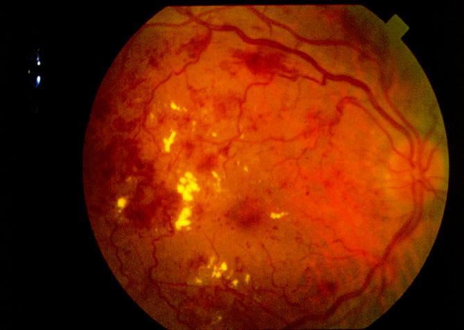 Diabetes And The Eye Hyperglycemia endothelial damage: loss of barrier function and leakage from vessels capillary fallout non-perfusion Retinal