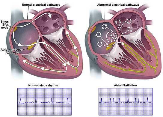 Atrial Fibrillation Atrial fibrillation (AF) is the most common heart rhythm disturbance It is estimated that 1